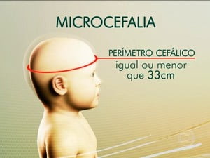Quatro casos de microcefalia são registrados no Sertão de PE
