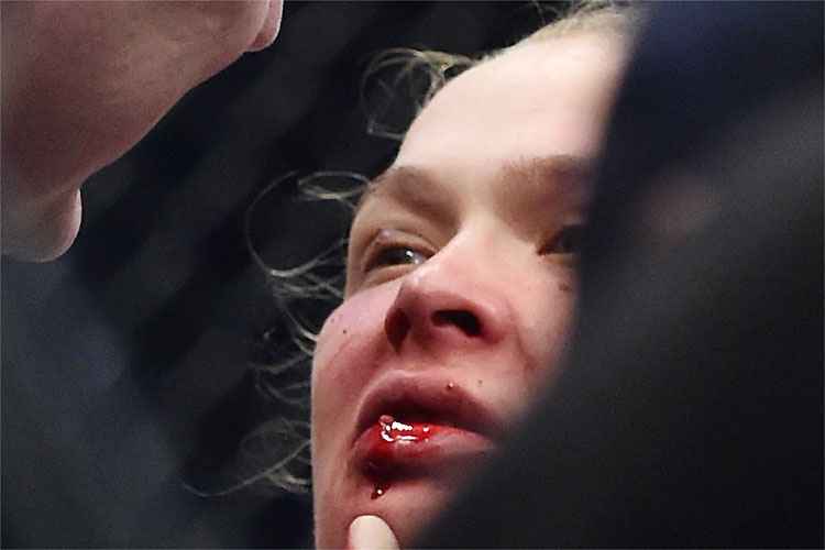 Ronda Rousey terá de passar por cirurgia plástica depois do nocaute sofrido contra Holly Holm