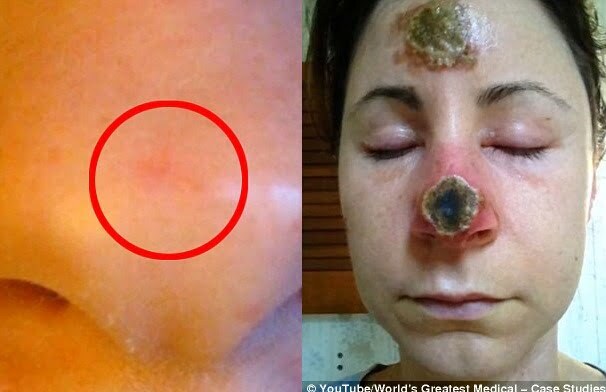 Mulher tem metade do nariz removido após pomada