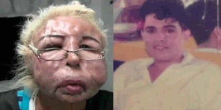 Obsessão: homem injeta óleo de bebê no rosto buscando “beleza perfeita” e fica desfigurado