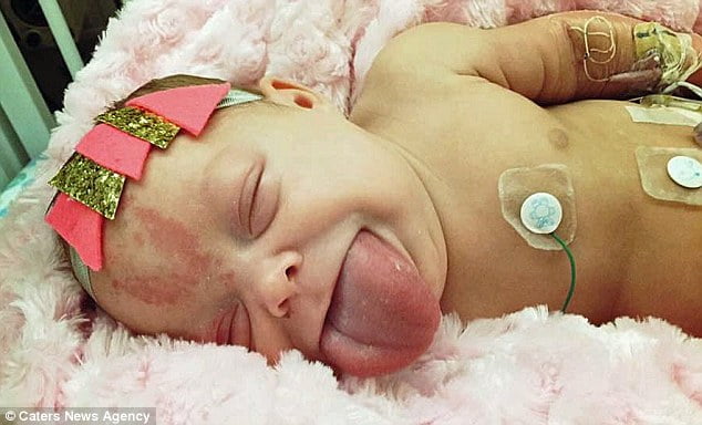 Bebê que poderia ter morrido sufocado com a própria língua passa por cirurgia