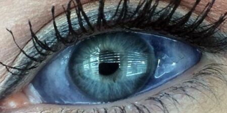 Mulher injeta tinta no globo ocular e corre o risco futuro de ficar cega