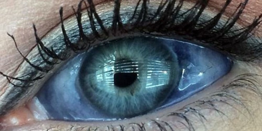 Mulher injeta tinta no globo ocular e corre o risco futuro de ficar cega