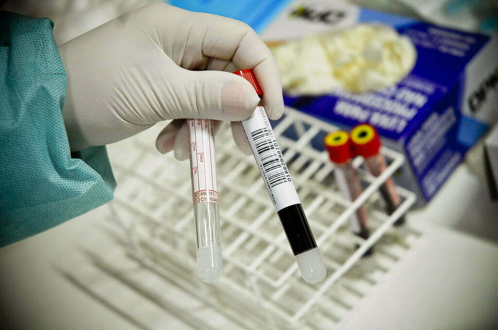 Nas últimas 24h, PE registra 603 novos casos e 11 óbitos pela Covid-19