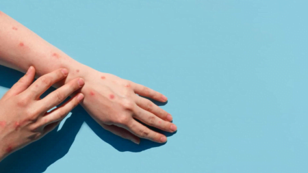 Varíola dos Macacos: SP cria rede de hospitais para a doença e prevê vacinar 5.500 pessoas